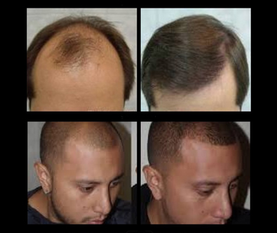 Successo clinica trapianto capelli fue